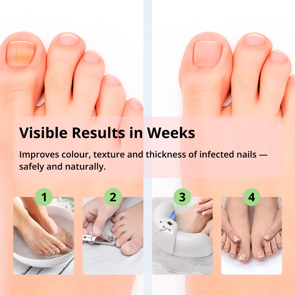 Laser Nail Fungus Treatment Device