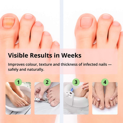 Laser Nail Fungus Treatment Device